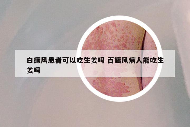 白癜风患者可以吃生姜吗 百癜风病人能吃生姜吗