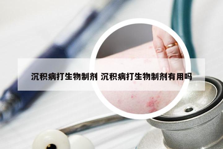 沉积病打生物制剂 沉积病打生物制剂有用吗