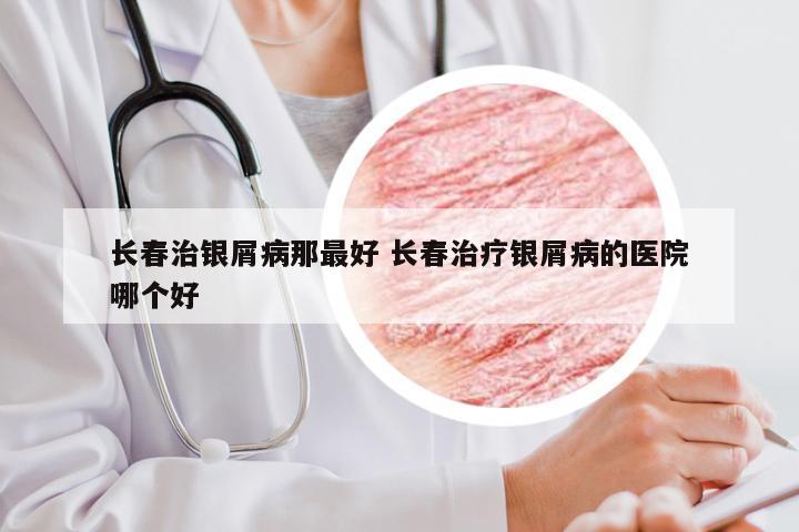 长春治银屑病那最好 长春治疗银屑病的医院哪个好