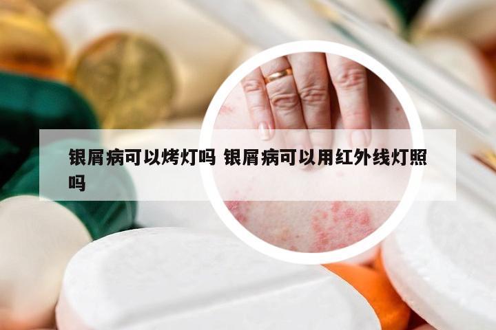 银屑病可以烤灯吗 银屑病可以用红外线灯照吗