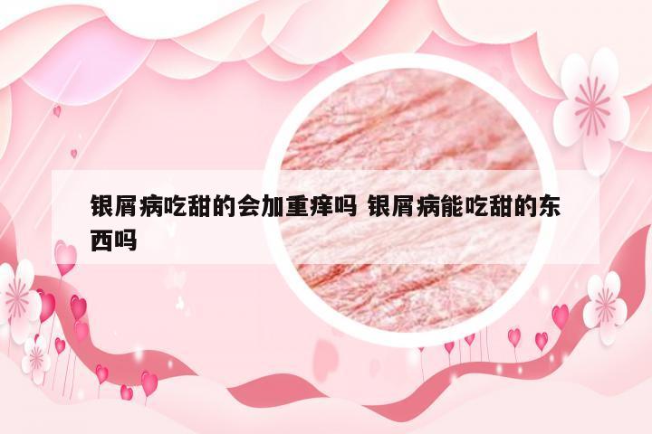 银屑病吃甜的会加重痒吗 银屑病能吃甜的东西吗