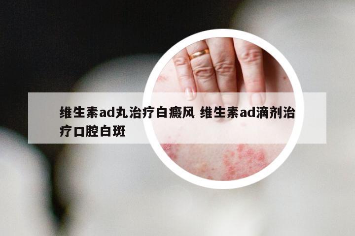 维生素ad丸治疗白癜风 维生素ad滴剂治疗口腔白斑