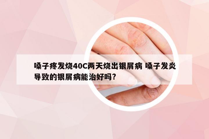 嗓子疼发烧40C两天烧出银屑病 嗓子发炎导致的银屑病能治好吗?