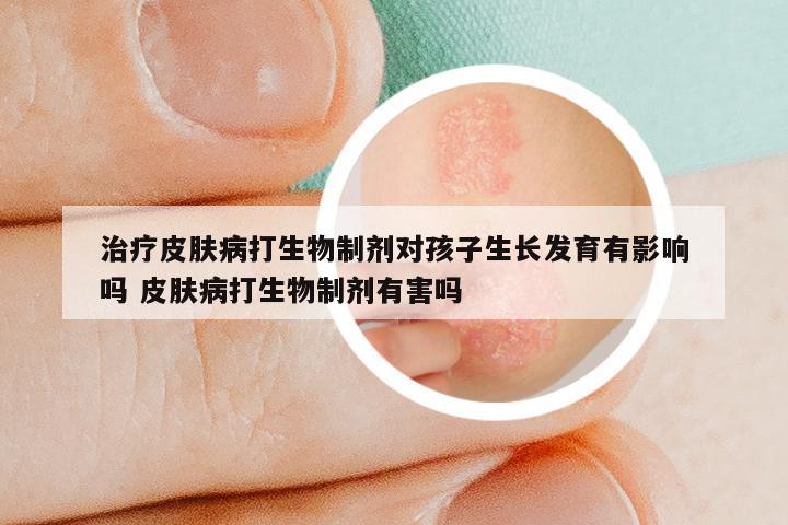 治疗皮肤病打生物制剂对孩子生长发育有影响吗 皮肤病打生物制剂有害吗