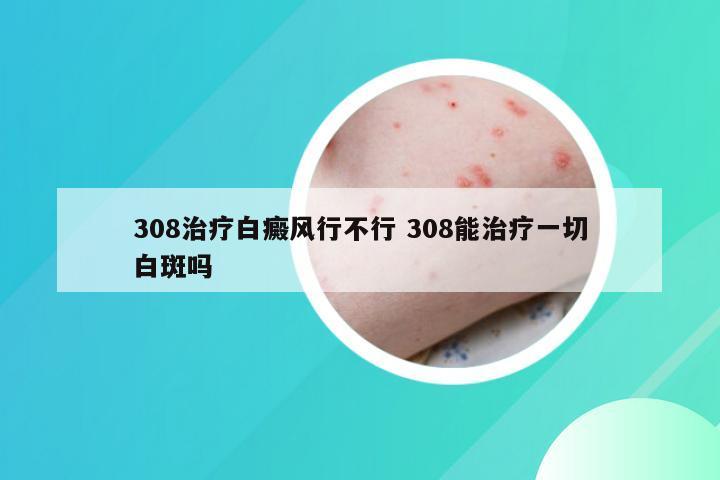 308治疗白癜风行不行 308能治疗一切白斑吗