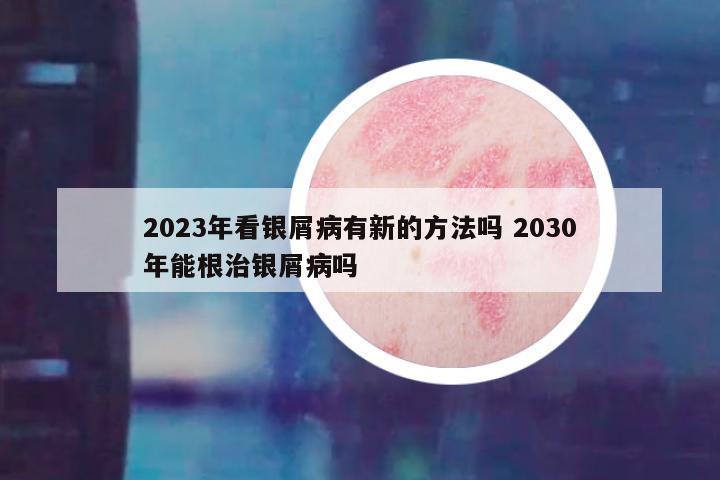 2023年看银屑病有新的方法吗 2030年能根治银屑病吗