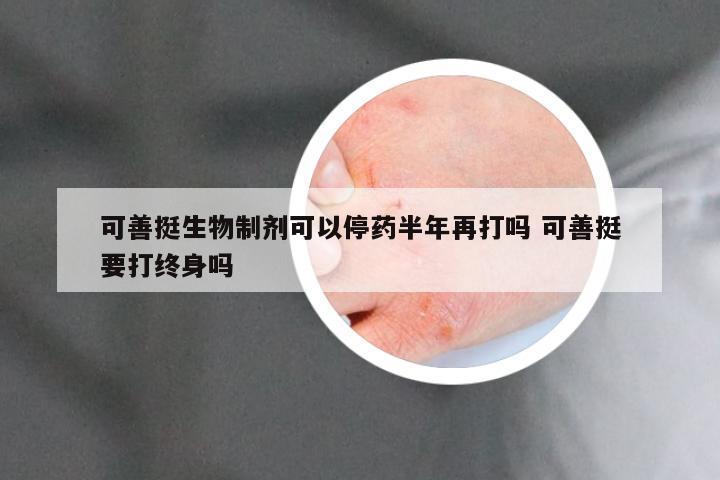 可善挺生物制剂可以停药半年再打吗 可善挺要打终身吗