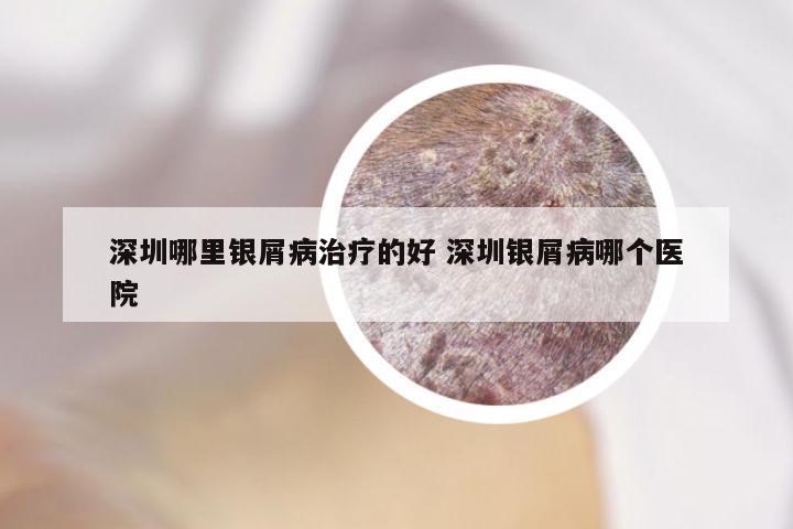 深圳哪里银屑病治疗的好 深圳银屑病哪个医院