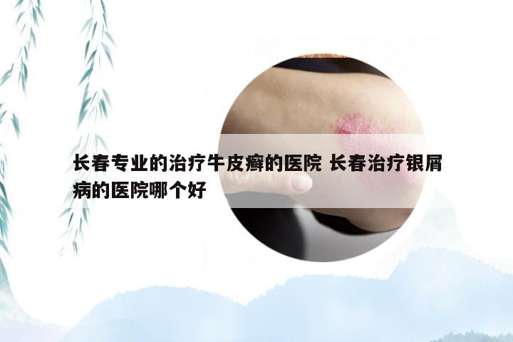 长春专业的治疗牛皮癣的医院 长春治疗银屑病的医院哪个好