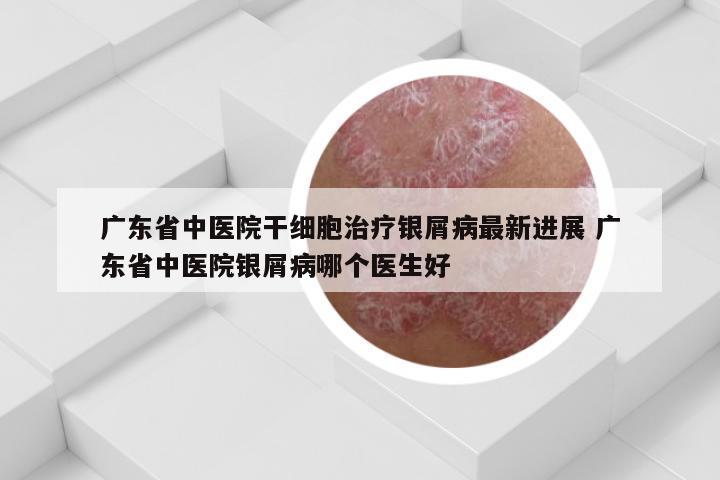 广东省中医院干细胞治疗银屑病最新进展 广东省中医院银屑病哪个医生好