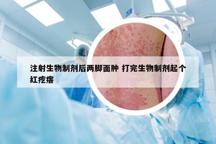 注射生物制剂后两脚面肿 打完生物制剂起个红疙瘩