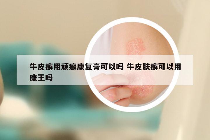 牛皮癣用顽癣康复膏可以吗 牛皮肤癣可以用康王吗