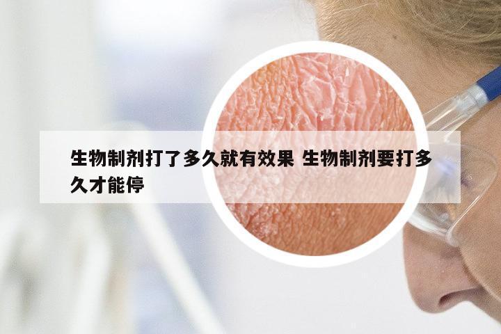 生物制剂打了多久就有效果 生物制剂要打多久才能停