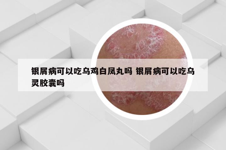 银屑病可以吃乌鸡白凤丸吗 银屑病可以吃乌灵胶囊吗