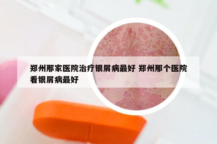 郑州那家医院治疗银屑病最好 郑州那个医院看银屑病最好