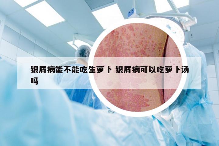 银屑病能不能吃生萝卜 银屑病可以吃萝卜汤吗