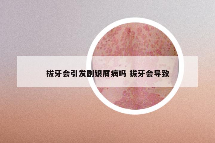 拔牙会引发副银屑病吗 拔牙会导致