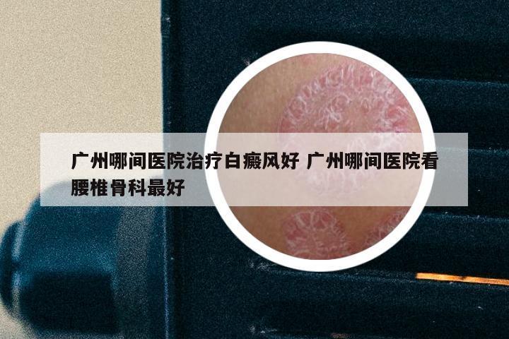 广州哪间医院治疗白癜风好 广州哪间医院看腰椎骨科最好