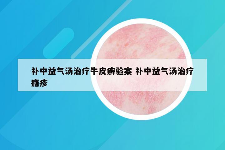 补中益气汤治疗牛皮癣验案 补中益气汤治疗瘾疹