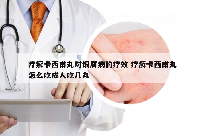 疗癣卡西甫丸对银屑病的疗效 疗癣卡西甫丸怎么吃成人吃几丸