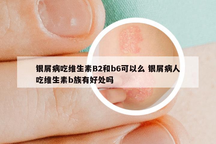 银屑病吃维生素B2和b6可以么 银屑病人吃维生素b族有好处吗