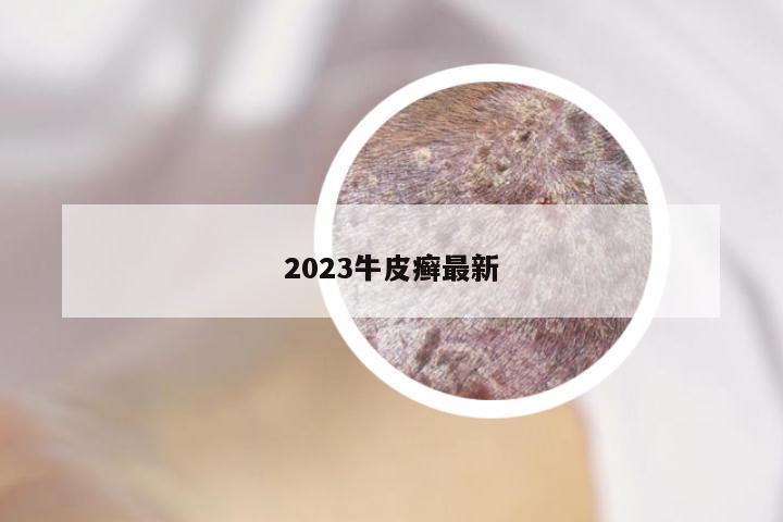 2023牛皮癣最新