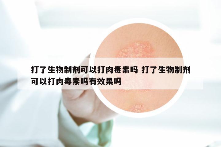 打了生物制剂可以打肉毒素吗 打了生物制剂可以打肉毒素吗有效果吗