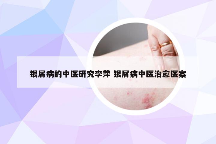 银屑病的中医研究李萍 银屑病中医治愈医案