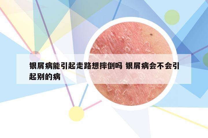 银屑病能引起走路想摔倒吗 银屑病会不会引起别的病