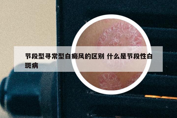 节段型寻常型白癜风的区别 什么是节段性白斑病