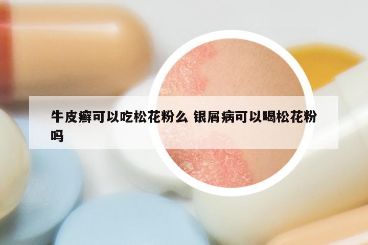 牛皮癣可以吃松花粉么 银屑病可以喝松花粉吗