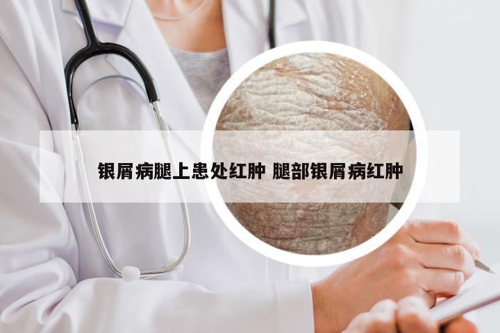 银屑病腿上患处红肿 腿部银屑病红肿