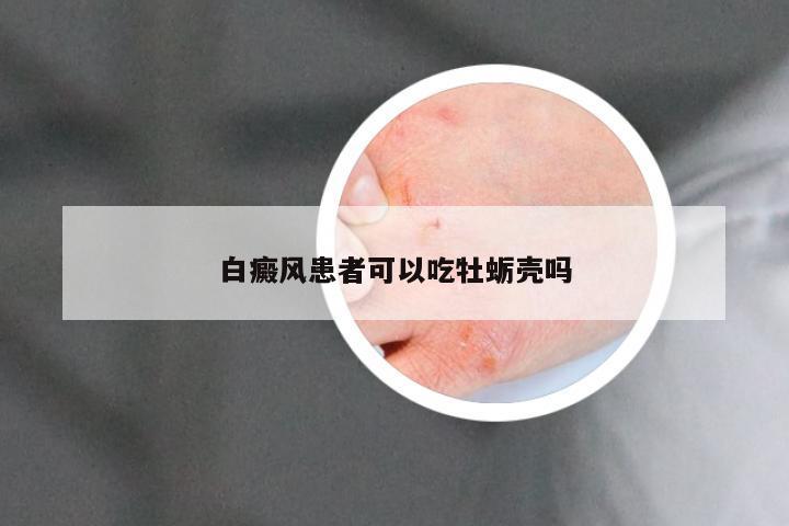 白癜风患者可以吃牡蛎壳吗