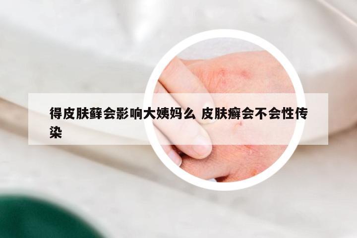 得皮肤藓会影响大姨妈么 皮肤癣会不会性传染