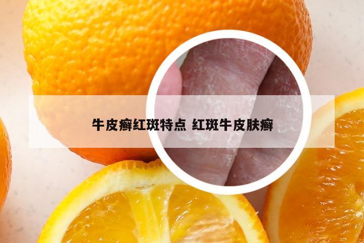 牛皮癣红斑特点 红斑牛皮肤癣