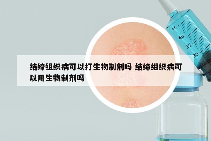 结缔组织病可以打生物制剂吗 结缔组织病可以用生物制剂吗