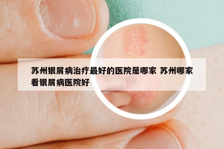 苏州银屑病治疗最好的医院是哪家 苏州哪家看银屑病医院好