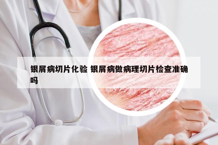 银屑病切片化验 银屑病做病理切片检查准确吗