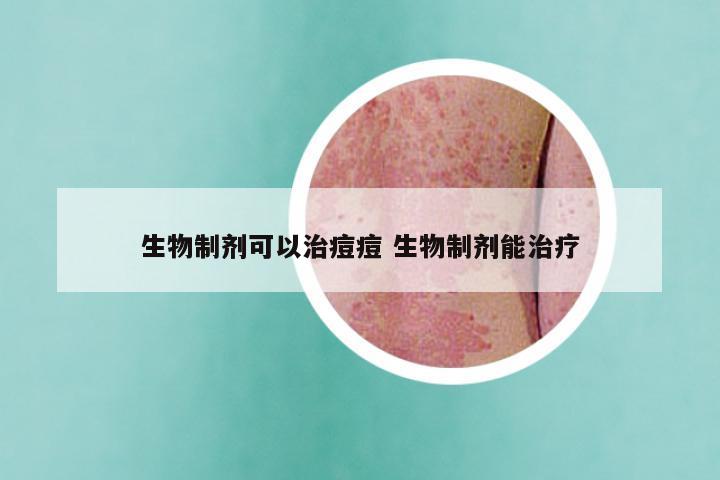 生物制剂可以治痘痘 生物制剂能治疗