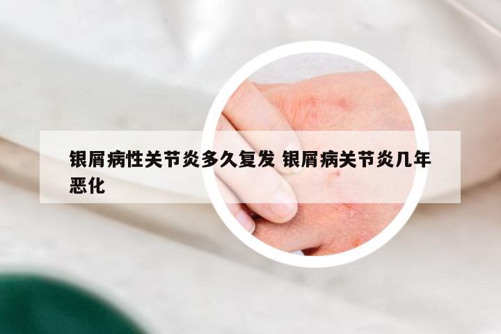 银屑病性关节炎多久复发 银屑病关节炎几年恶化