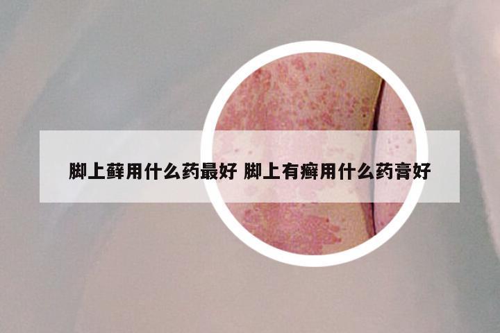 脚上藓用什么药最好 脚上有癣用什么药膏好