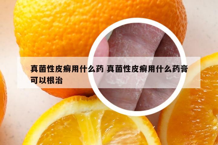 真菌性皮癣用什么药 真菌性皮癣用什么药膏可以根治