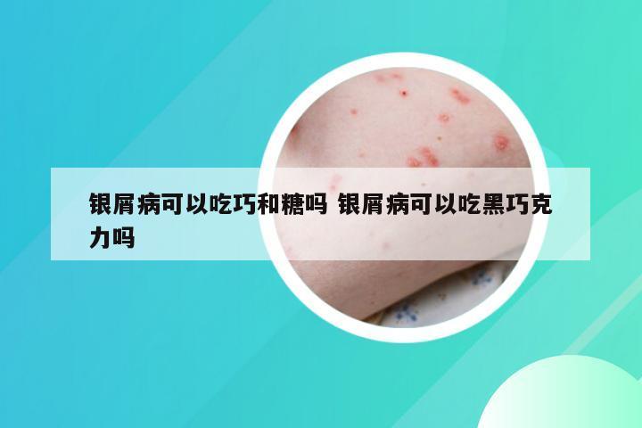 银屑病可以吃巧和糖吗 银屑病可以吃黑巧克力吗