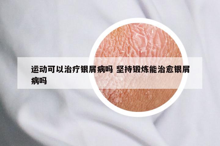 运动可以治疗银屑病吗 坚持锻炼能治愈银屑病吗