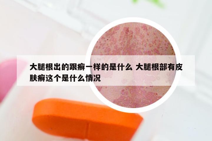 大腿根出的跟癣一样的是什么 大腿根部有皮肤癣这个是什么情况