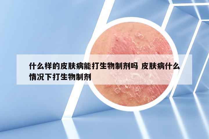 什么样的皮肤病能打生物制剂吗 皮肤病什么情况下打生物制剂