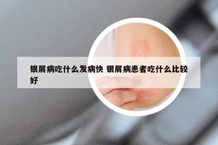 银屑病吃什么发病快 银屑病患者吃什么比较好