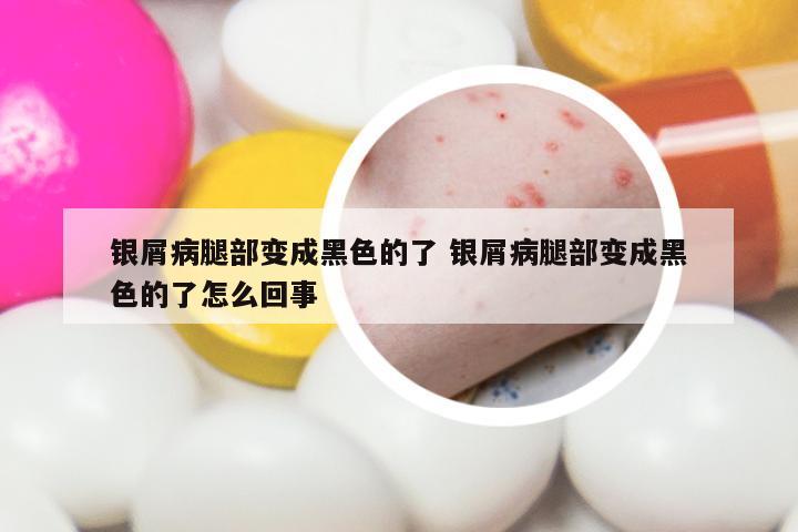 银屑病腿部变成黑色的了 银屑病腿部变成黑色的了怎么回事