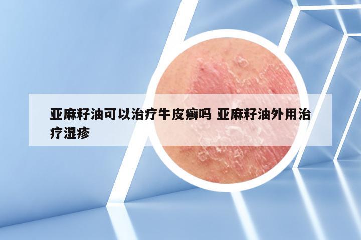 亚麻籽油可以治疗牛皮癣吗 亚麻籽油外用治疗湿疹