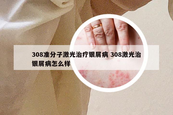 308准分子激光治疗银屑病 308激光治银屑病怎么样